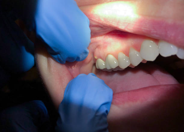 Best Emergency Gum Treatment in Belterra, TX
